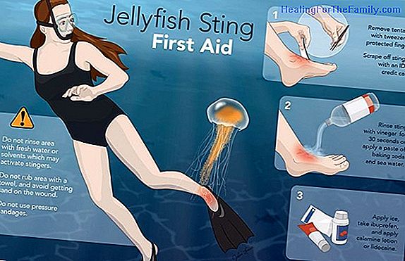 How to treat jellyfish stings in children