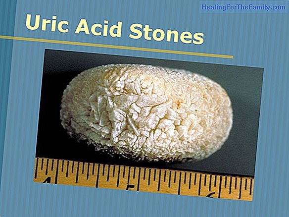 Stones in the kidney during childhood