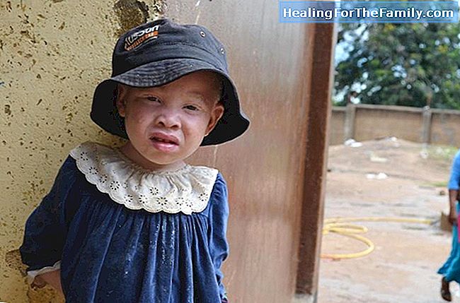 Albino-Kinder. Albinismus in der Kindheit