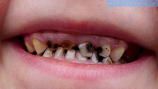 Ursachen der Zähne angehäuft Kinder