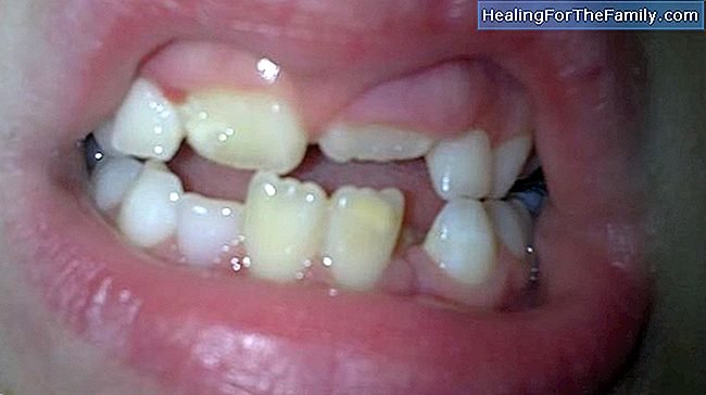 Bleibende Zähne von Kindern