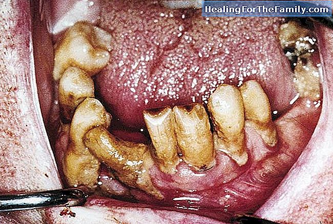 Geschwüre und Entzündungen im Mund des Kindes