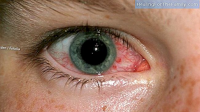 Was ist trockenes Auge und wie man es bei Kindern behandelt