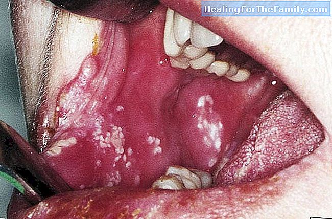 Was ist Gingivostomatitis? Schwellungen im Mund von Säuglingen und Kindern