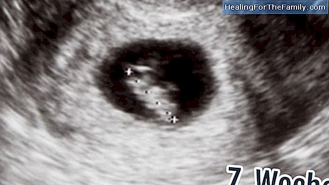 Ultraschall im ersten Trimester der Schwangerschaft