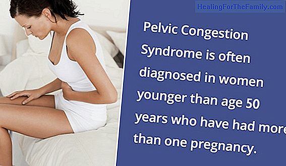 Pelvic congestion after pregnancy