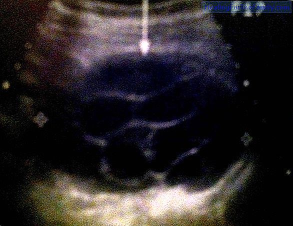 Mole or startle reflex in the newborn baby