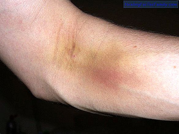Hematomas and bruises on the legs of children