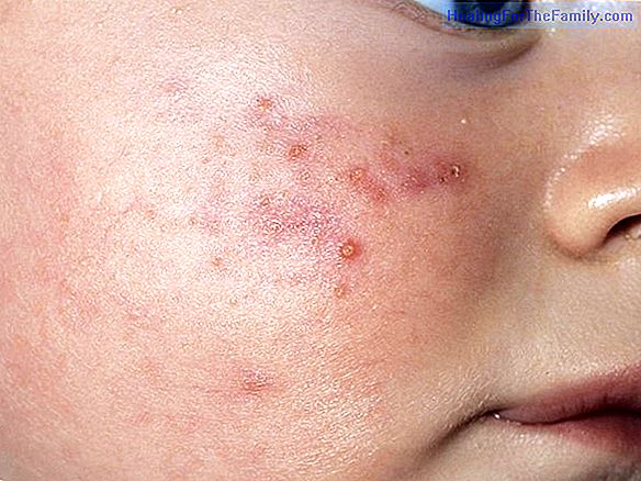 Causes of acne in childhood