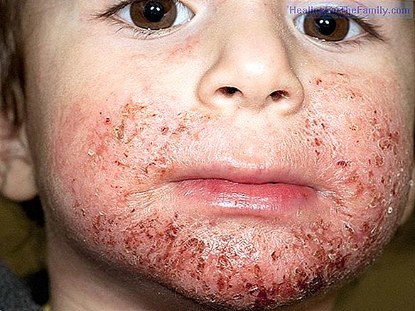 Child atopic dermatitis according to the season