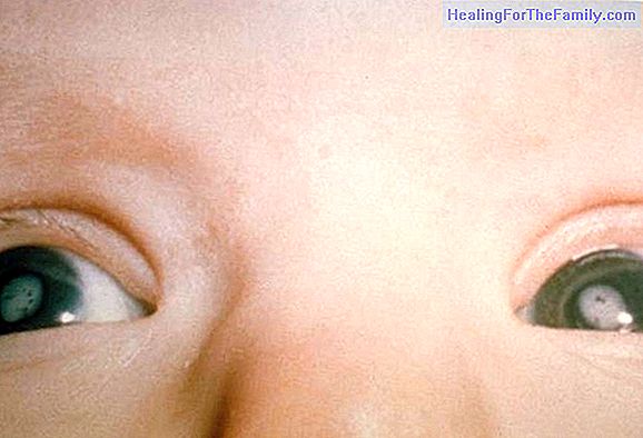 Congenital cataracts in children