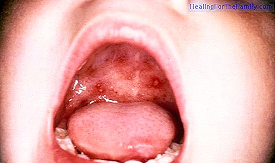 Hand-foot-mouth disease in children. Symptoms and treatment