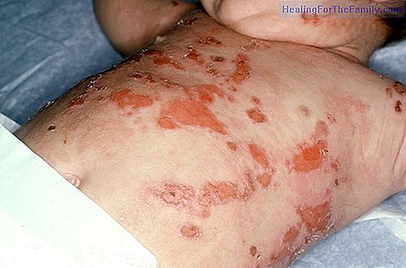 Hepatitis C in children