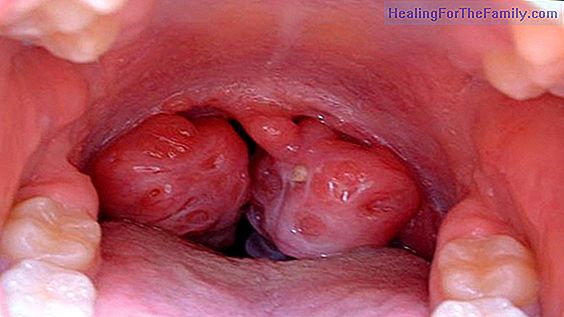 Home remedies for sore throat in children