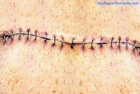 How to care for a wound with stitches or staples in children