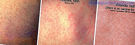 How to differentiate measles, varicella and rubella in children