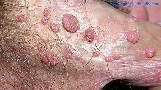 Human Papilloma Virus in children