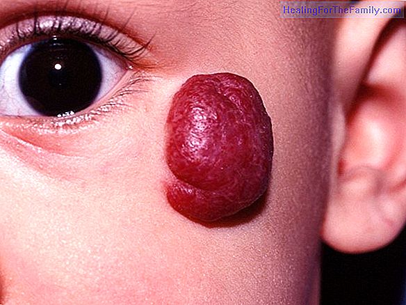 Infantile dyslalia in children from 4 years of age