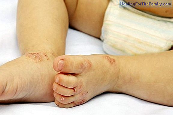 Photographs to recognize the hand-foot-mouth virus in babies