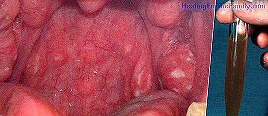 Streptococcal infection in children