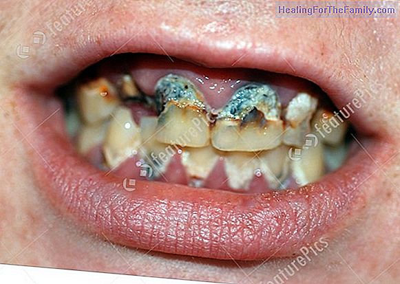 Tartar in children's teeth
