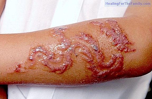 The risks of henna tattoos for children