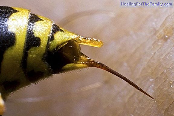 Tips to cure a wasp sting in children