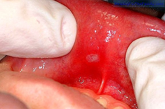 Ulcers and sores in the child's mouth