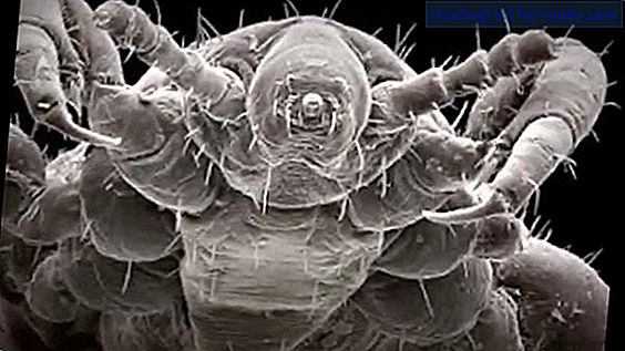 Videos about lice and pediculosis