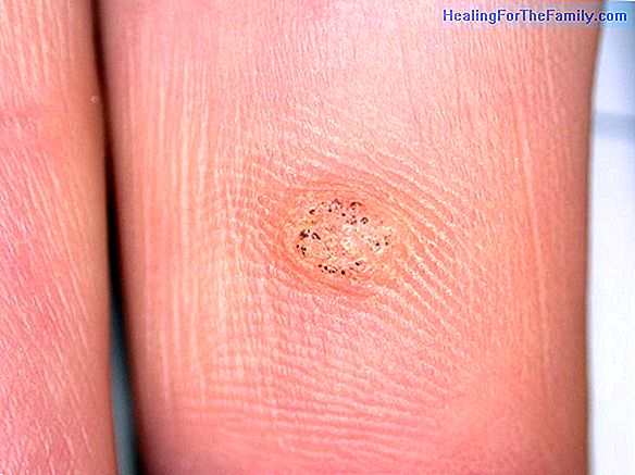 Warts in children. Causes and treatment