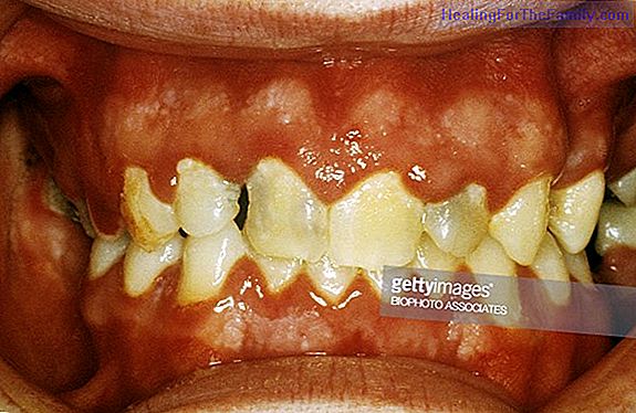 What is gingivostomatitis. Inflammation in the mouth of babies and children