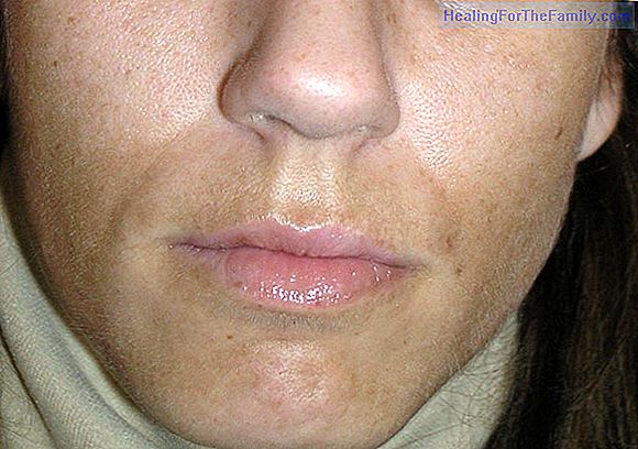 Chloasma or pregnancy spots on the face