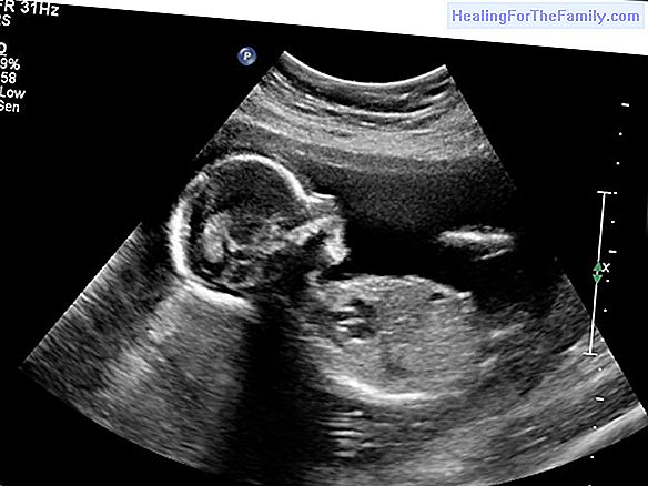 Ultrasound in the second trimester of pregnancy