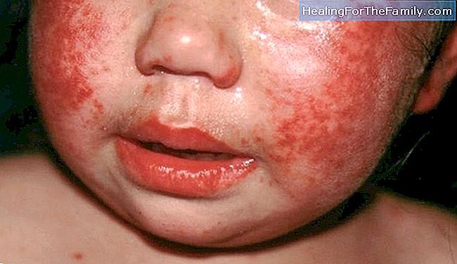 Doença de espirros ou eritema infeccioso em bebês e crianças