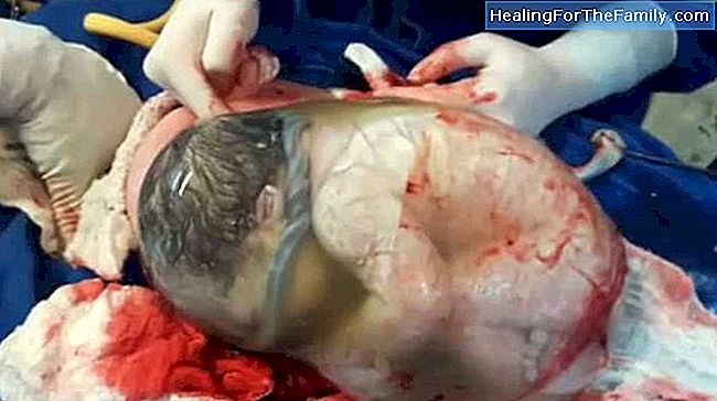 Nourrir un bébé avec des implants en silicone