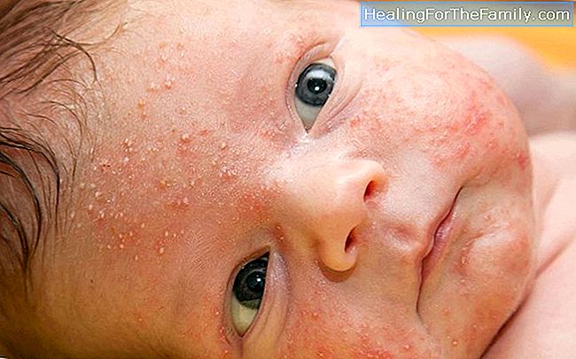 7 Doutes sur la dermatite atopique chez les nourrissons et les enfants