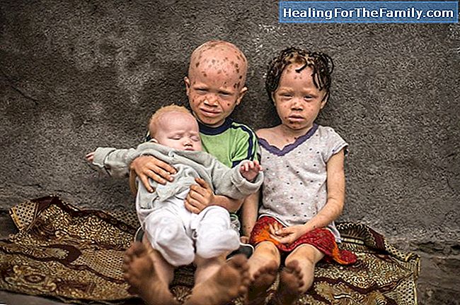 Enfants albinos. Albinisme dans l'enfance