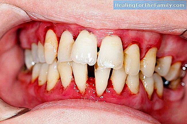 Causes de dents entassées les enfants