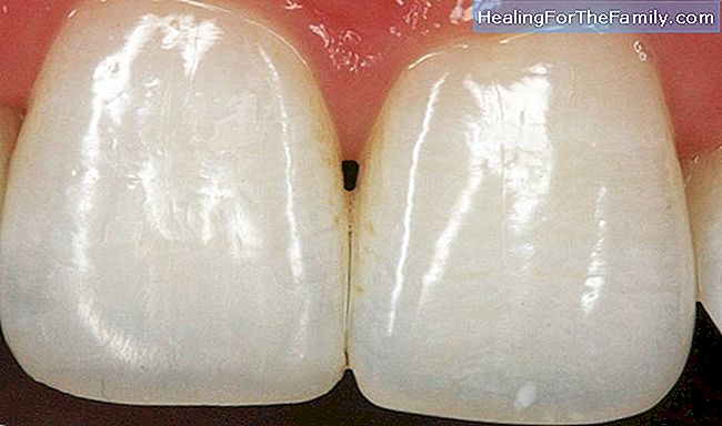 Canaux radiculaires dans les dents des enfants