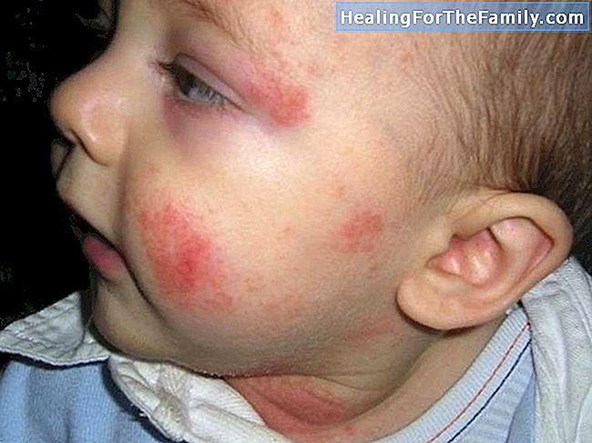 I bambini con allergie cutanee
