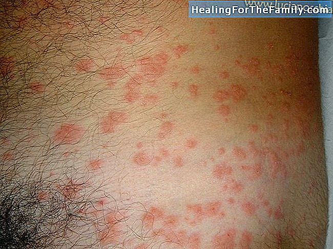 Tipi di reazioni allergiche alle punture di insetti nei bambini