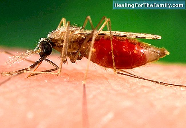 Qual è la malaria e come colpisce i bambini