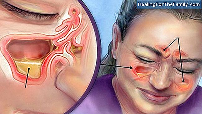 גודש באף במהלך ההריון