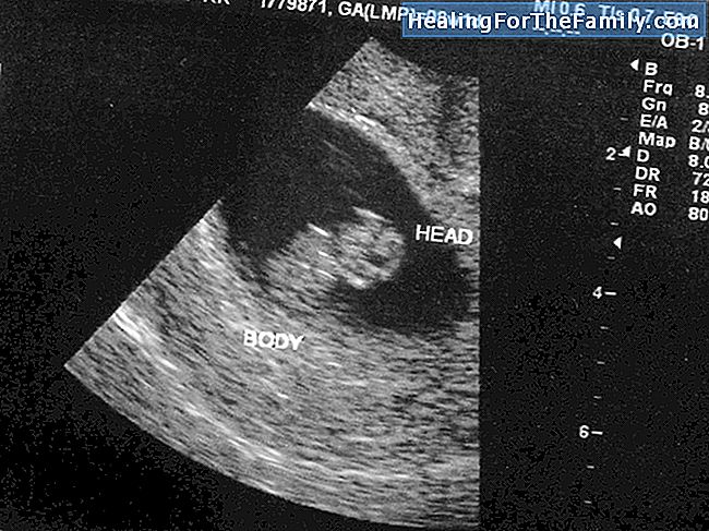 אולטרסאונד בשליש הראשון של ההריון