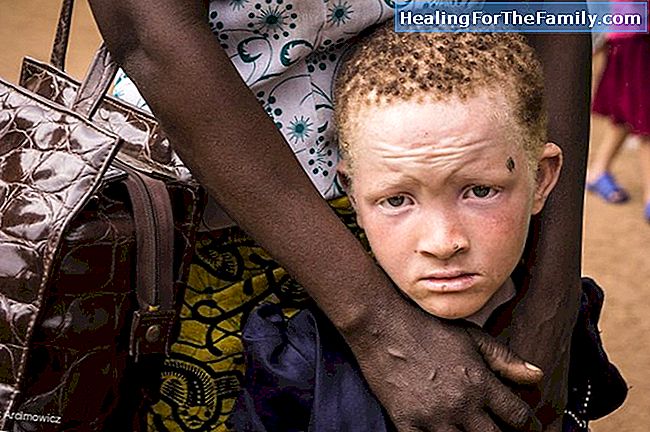 Albinokinderen. Albinisme in de kindertijd