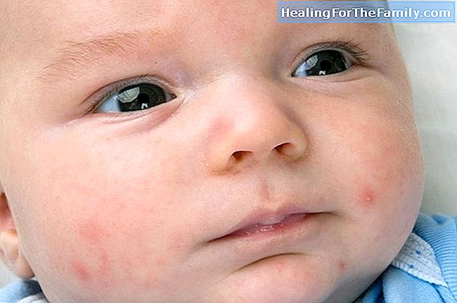 Oorzaken van acne in de kindertijd
