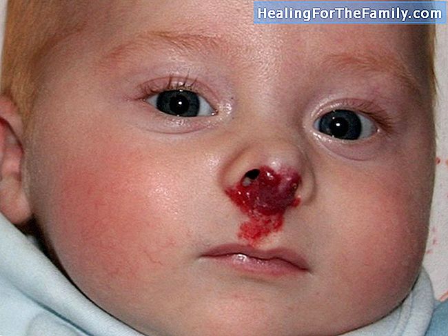 Hemangiomen huid van de baby