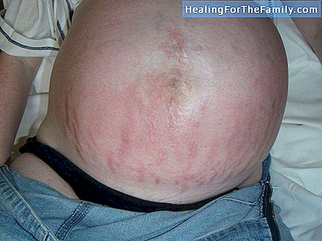 Vormen van pijn in de rug tijdens de zwangerschap