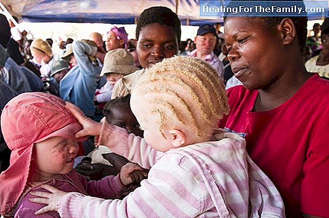 Albino barn. Albinisme i barndommen