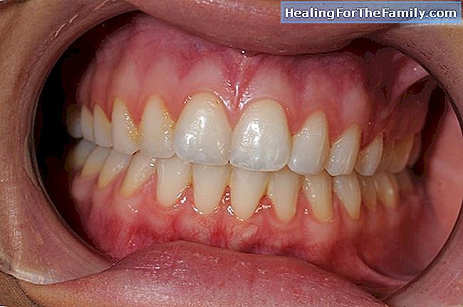 Tannsten på tennene hos barn